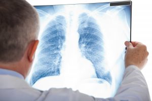 The role of imaging in the diagnosis of lung cancer in primary care (PhD)