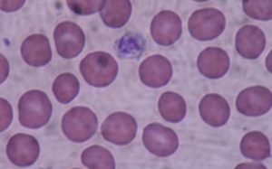 Are patients with high-normal platelet counts at increased risk of cancer?