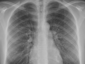 Risk of lung cancer in symptomatic patients with negative chest x-ray results