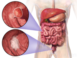 Diagnostic accuracy of FIT in patients urgently referred for colorectal cancer