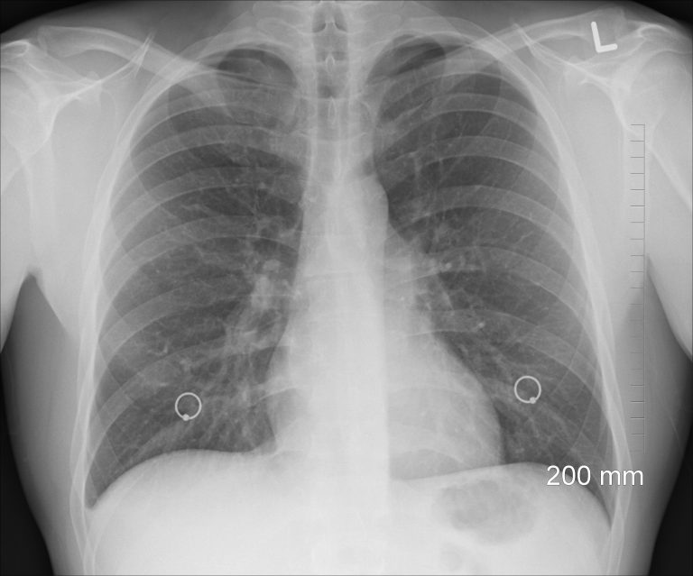 Study shows chest xrays miss up to a fifth of lung cancer cases CanTest
