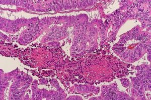 Patterns of clinical features prior to diagnosis in patients with colorectal cancer: a retrospective cohort study